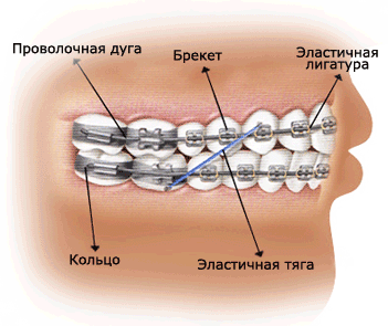 Как выбрать брекеты